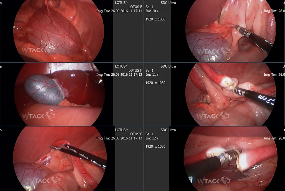 Minimal Invasive Chirurgie Galerie Bild 5