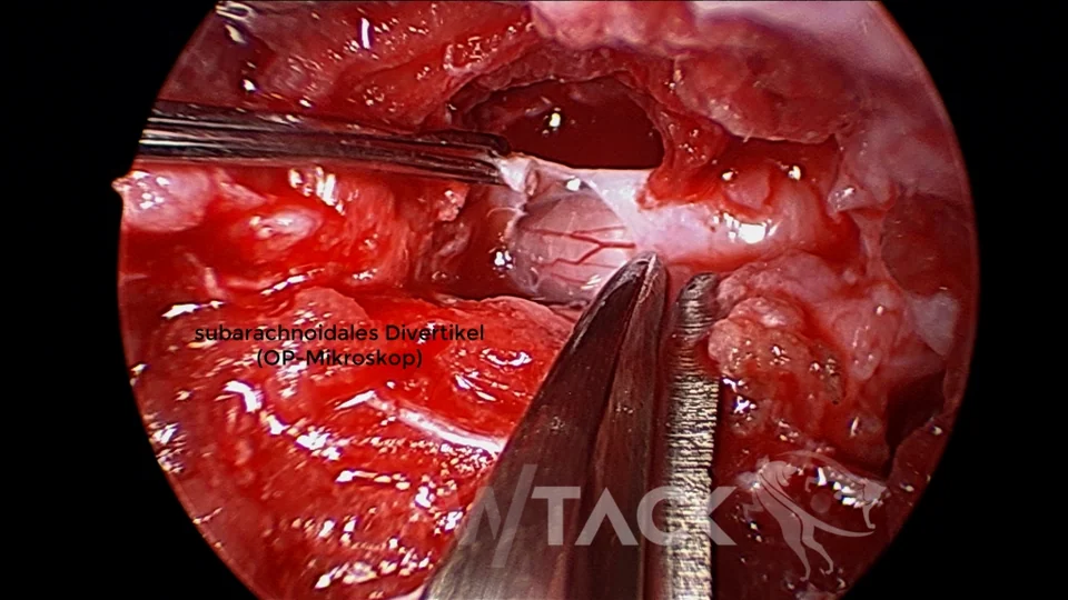 Neuro-Chirurgie Galerie Bild 7
